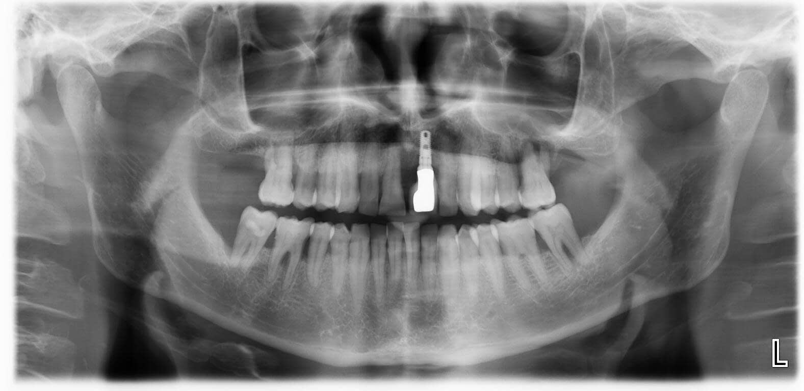 Radiografía digital dental en Santiago de Compostela