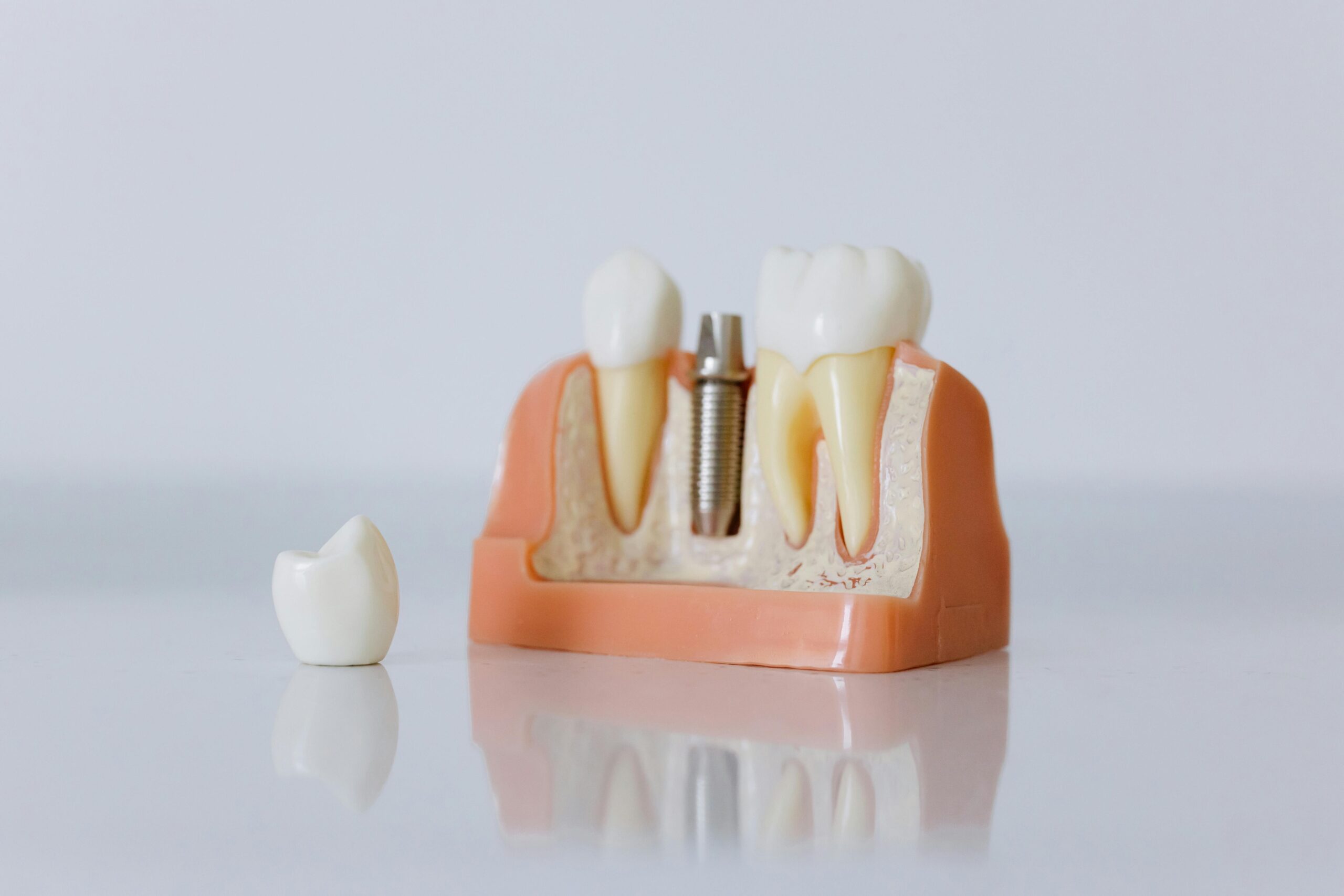 Implantes dentales en Santiago de Compostela