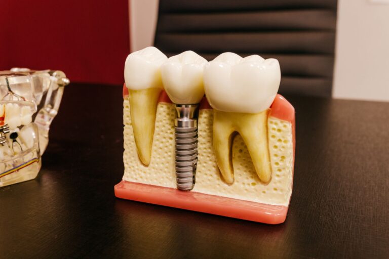 Odontólogo explicando el precio y las fases de un implante dental con un modelo en consulta