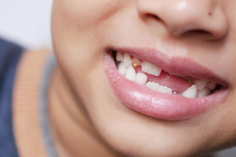 Sonrisa con dientes separados (diastema) antes de valorar el tratamiento
